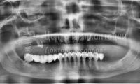 Восстановление зубов на верхней челюсти - Фотография 3